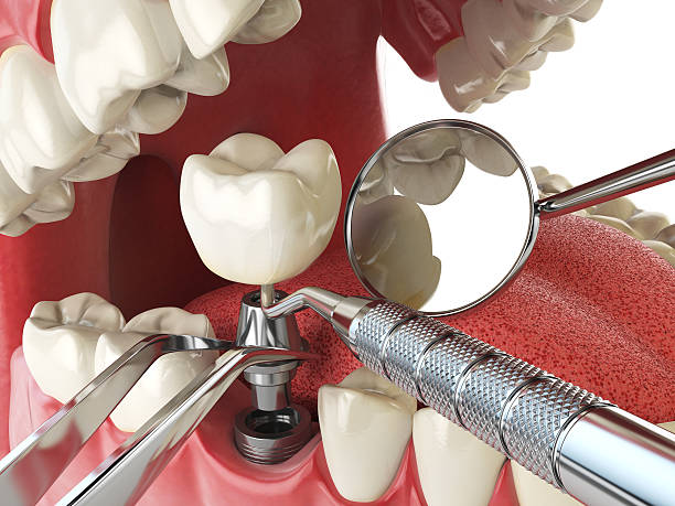 Best Emergency Root Canal Treatment in Lorton, VA